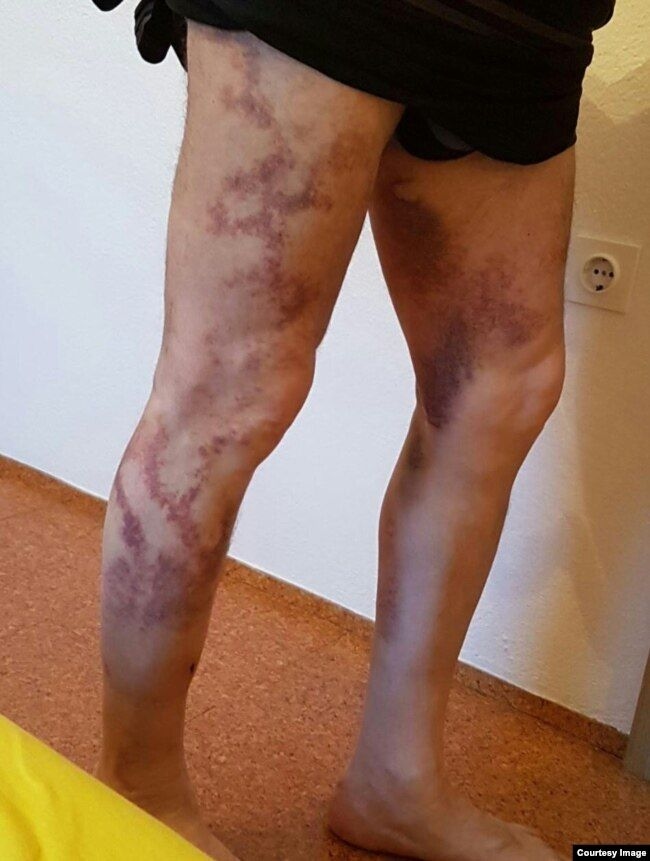 Фото Элбиева после пыток