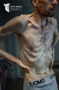 Истощенный работник ЧАЭС Роман Горилык после возвращения из российского плена