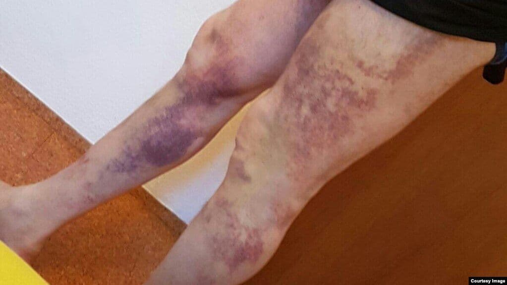 Фото Элбиева после пыток